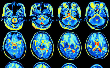 Functional MRI used to investigate new drugs for drug relapse prevention