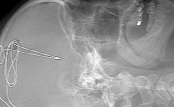 Brain Implant to Combat Addiction? First ever U.S. trial of a “pacemaker for the brain” for treatment resistant opioid use disorder